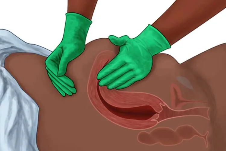 Postpartum Fundal Assessment Technique