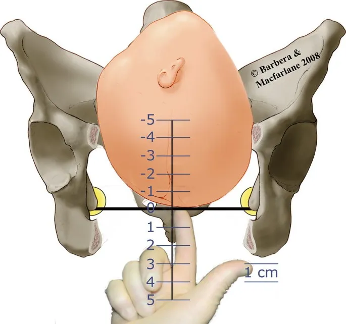 Fetal head station diagram with pelvic bones and fingers