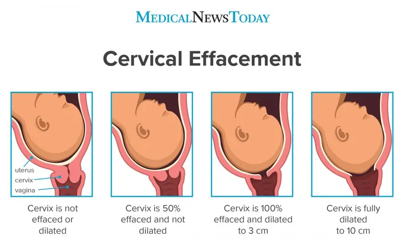 Cervical effacement and dilation stages
