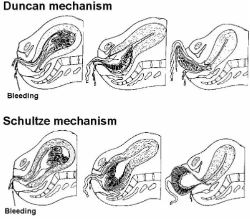 Duncan and Schultze mechanisms of placental separation