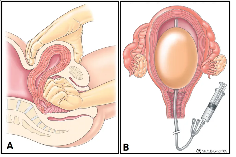 Bimanual compression and balloon tamponade for PPH