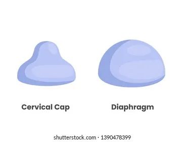 Diaphragm and cervical cap medical illustration