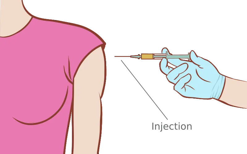 Intramuscular DMPA injection site