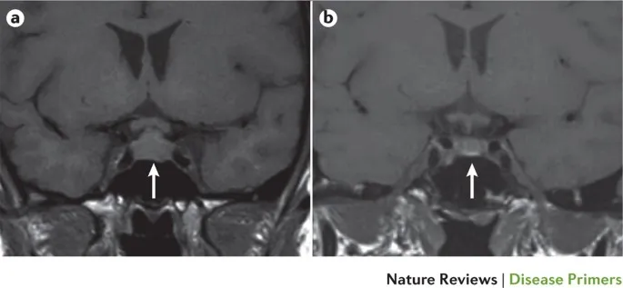 MRI of pituitary gland in Sheehan's syndrome