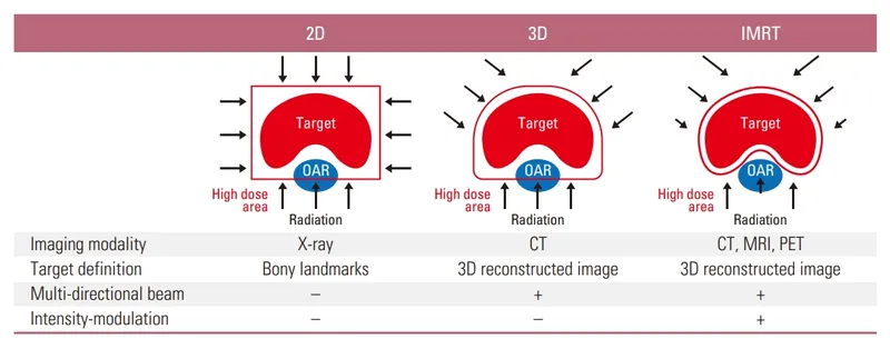 2D, 3D, and IMRT Radiation Therapy Comparison