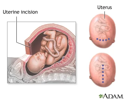 LSCS vs Classical C-section uterine incisions