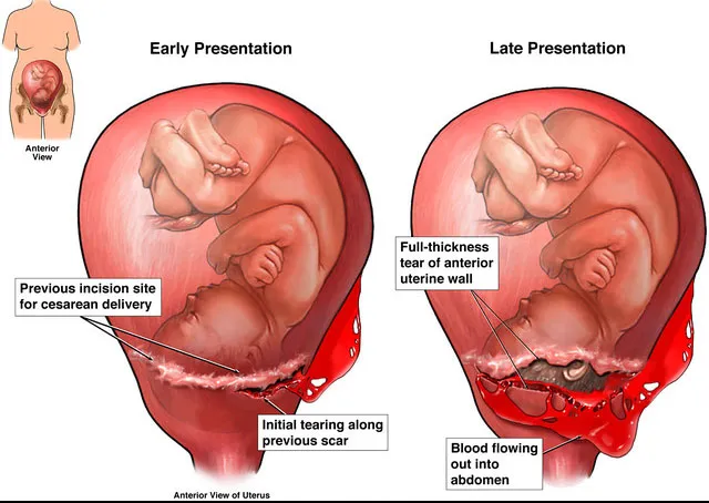 Uterine Rupture at Previous Cesarean Scar Site