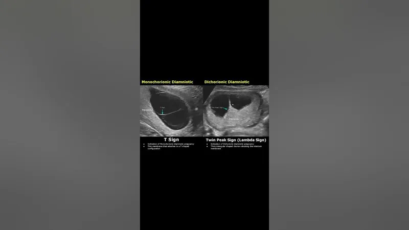 Ultrasound: T Sign vs Lambda Sign in Twin Pregnancy
