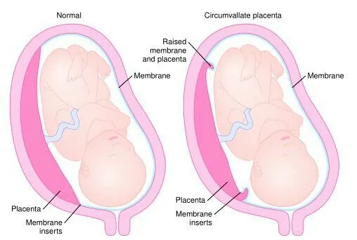 Normal vs. Circumvallate Placenta Diagram