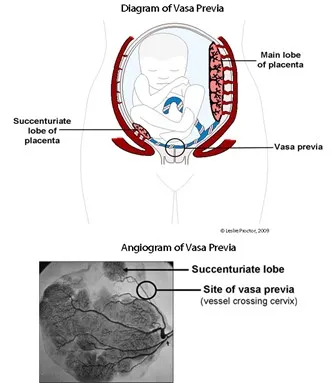Vasa previa and succenturiate lobe
