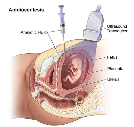 Amniocentesis procedure with ultrasound guidance
