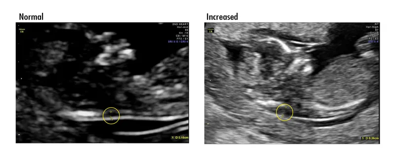Normal vs. Increased Nuchal Translucency Ultrasound
