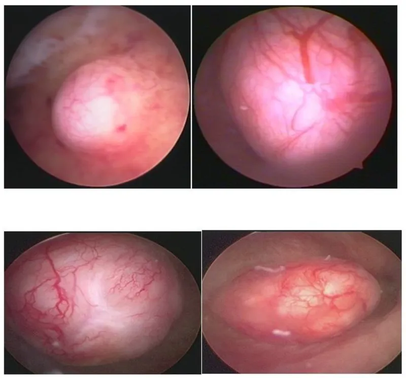 Hysteroscopic view of intrauterine polyps