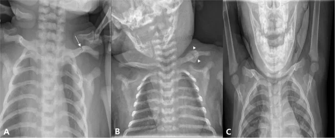 Neonatal clavicular fracture X-rays