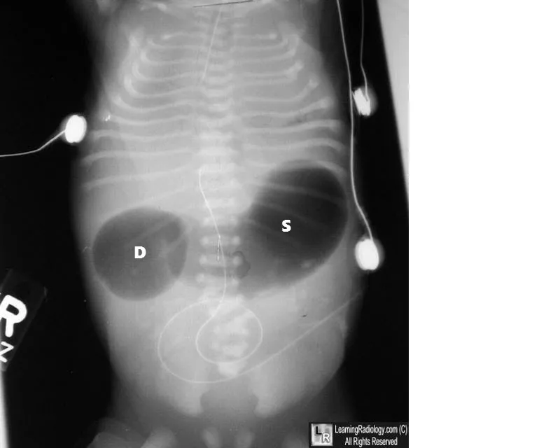 Double bubble sign in duodenal atresia