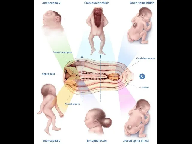 Neural tube defects and related congenital anomalies