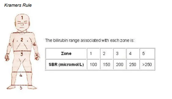 Kramer's Rule: Jaundice Zones and Bilirubin Levels