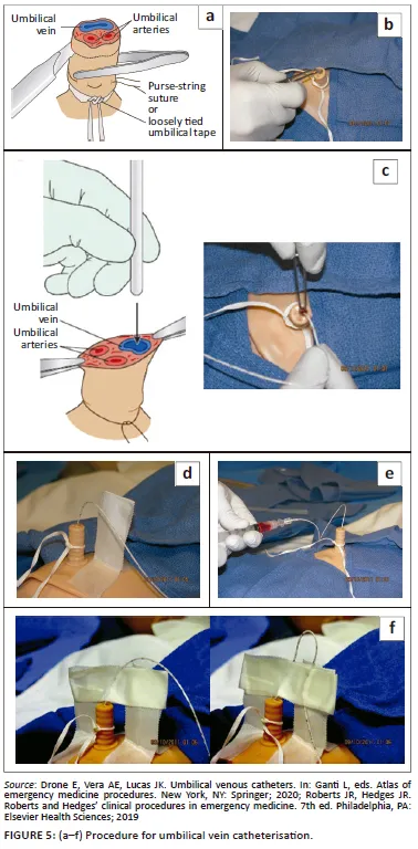 Umbilical vein catheterization procedure steps