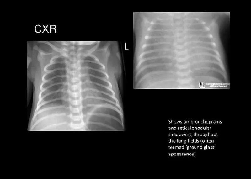 Neonatal RDS CXR with ground glass appearance