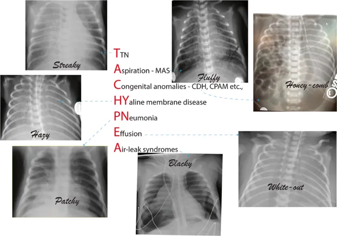 Neonatal Chest X-Ray Findings in Respiratory Distress