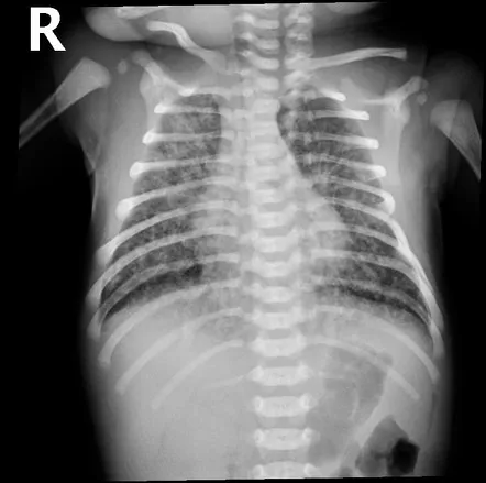 Chest X-ray: Meconium Aspiration Syndrome