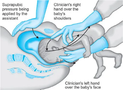 Mauriceau-Smellie-Veit maneuver