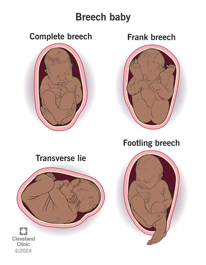 Breech baby presentations: Complete, Frank, Footling