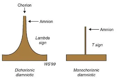 Lambda and T signs in twin pregnancies