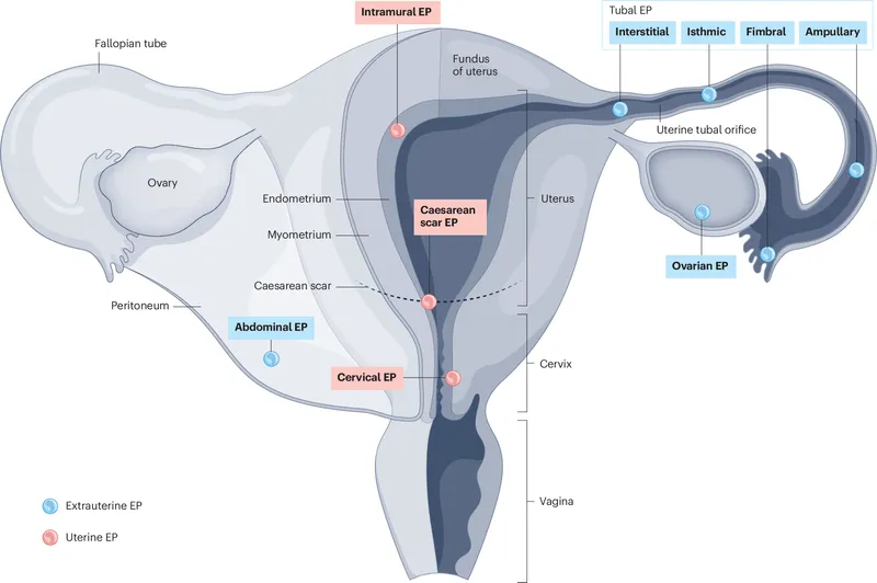 Locations of ectopic pregnancy