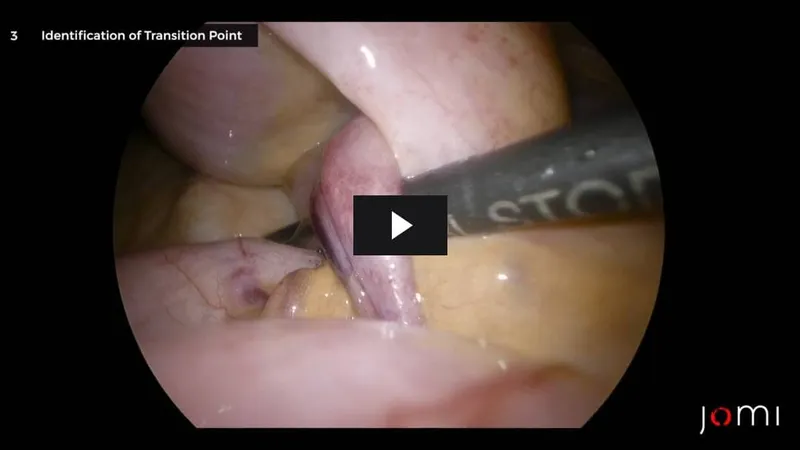 Laparoscopic view of pelvic adhesions