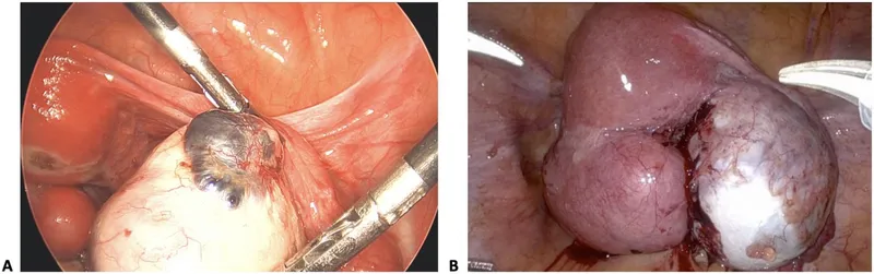 Laparoscopic view of endometriosis implants