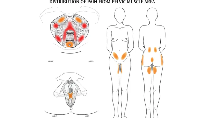 Pelvic muscle pain referral patterns