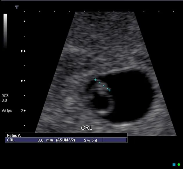 TVS showing gestational sac, yolk sac, fetal pole with CRL