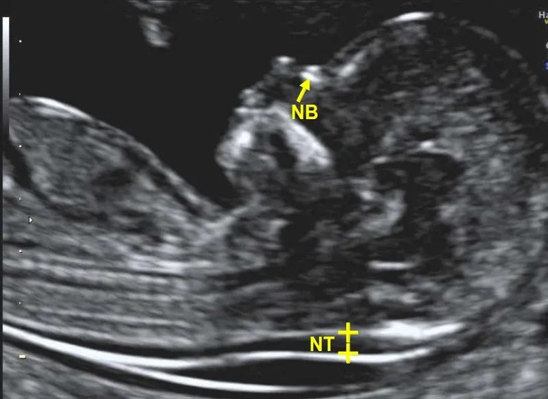 Fetal ultrasound: Nuchal translucency and nasal bone