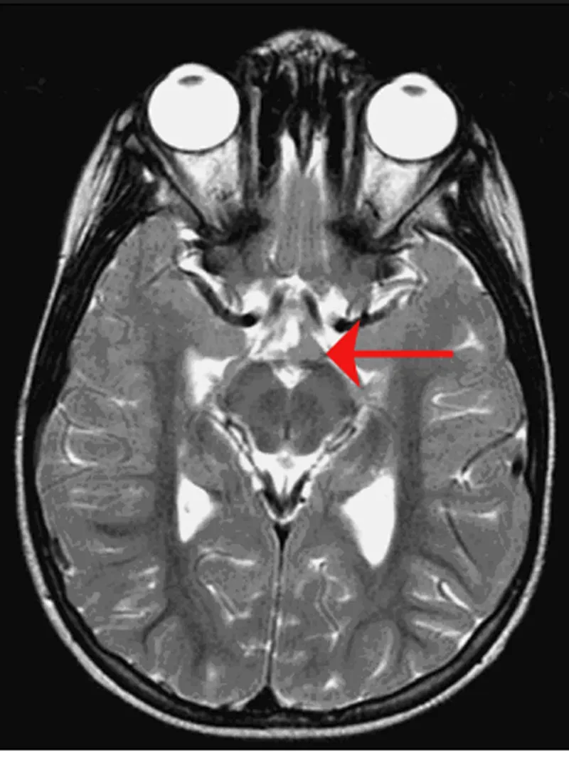 MRI showing hypothalamic hamartoma