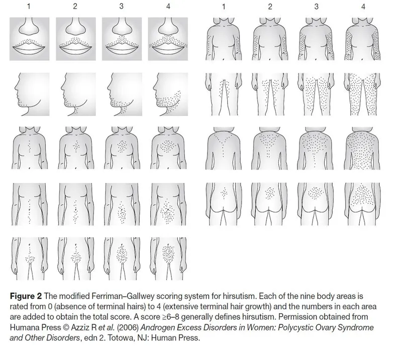 Modified Ferriman-Gallwey scoring system for hirsutism