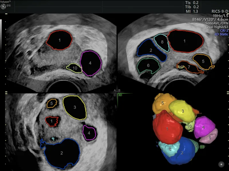 Transvaginal ultrasound of antral follicles