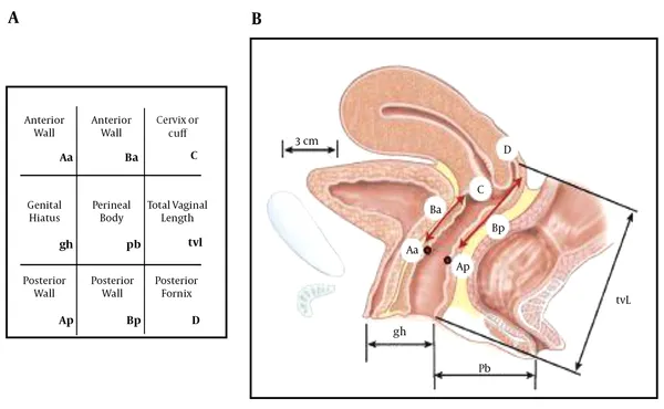 POP-Q grid and diagram for pelvic organ prolapse staging