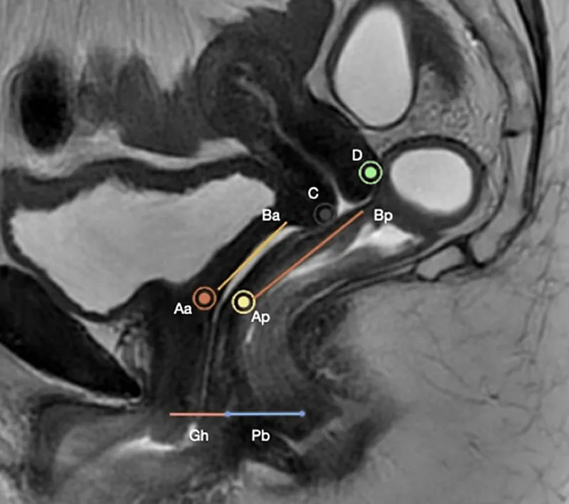 Rectocele vs Enterocele Sagittal Anatomy