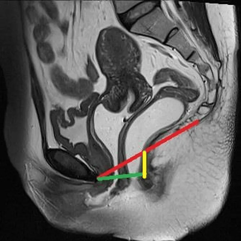 Rectocele & Enterocele Sagittal View