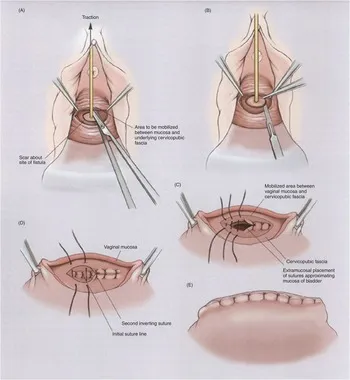 Vesicovaginal fistula repair with layered closure