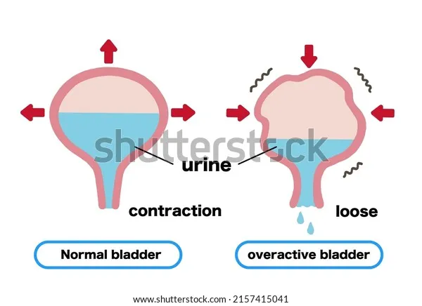 Overactive Bladder Mechanism