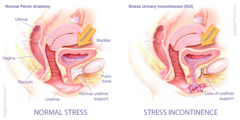 Normal vs. Stress Urinary Incontinence
