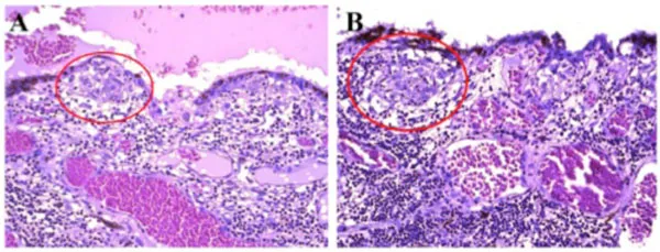 Dalen-Fuchs nodules histopathology