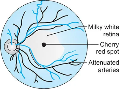 Fundus with cherry-red spot and attenuated arteries