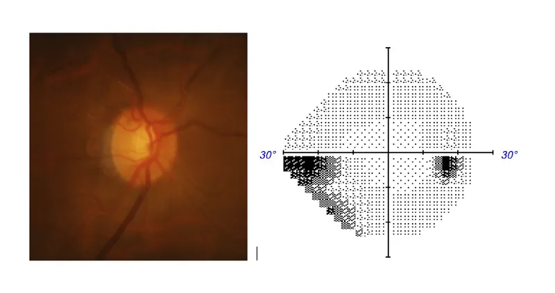 Glaucoma: Optic disc cupping and visual field loss