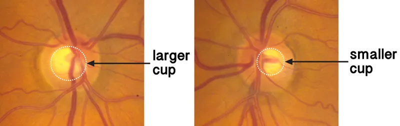 Optic disc cupping comparison