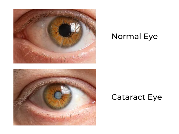 Clear eye vs. eye with cataract