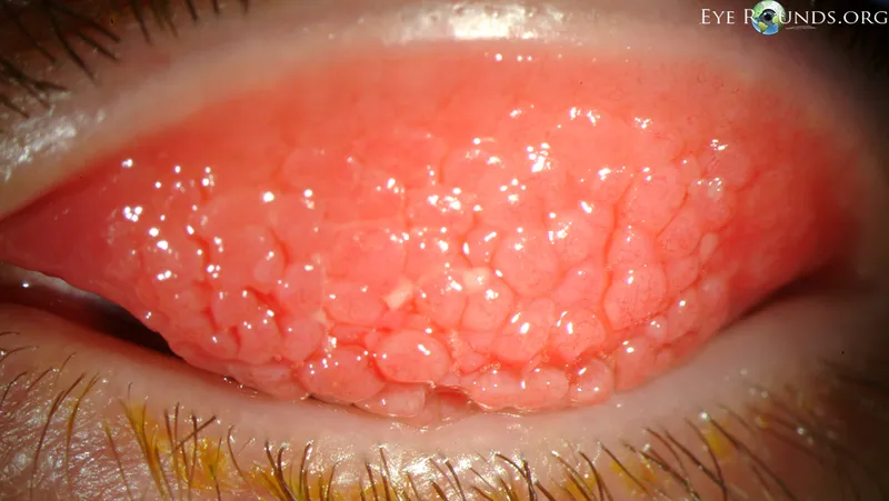 Giant Papillary Conjunctivitis cobblestone papillae