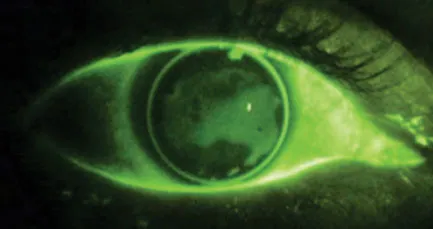 Fluorescein pattern of RGP lens on eye